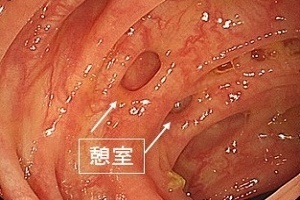大腸憩室炎